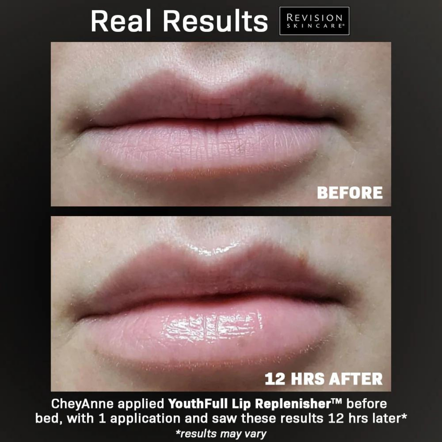 YouthFull Lip Replenisher® | Revision Skincare