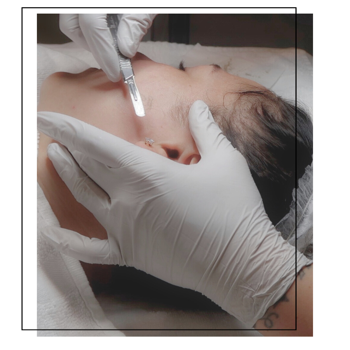 Dermaplaning