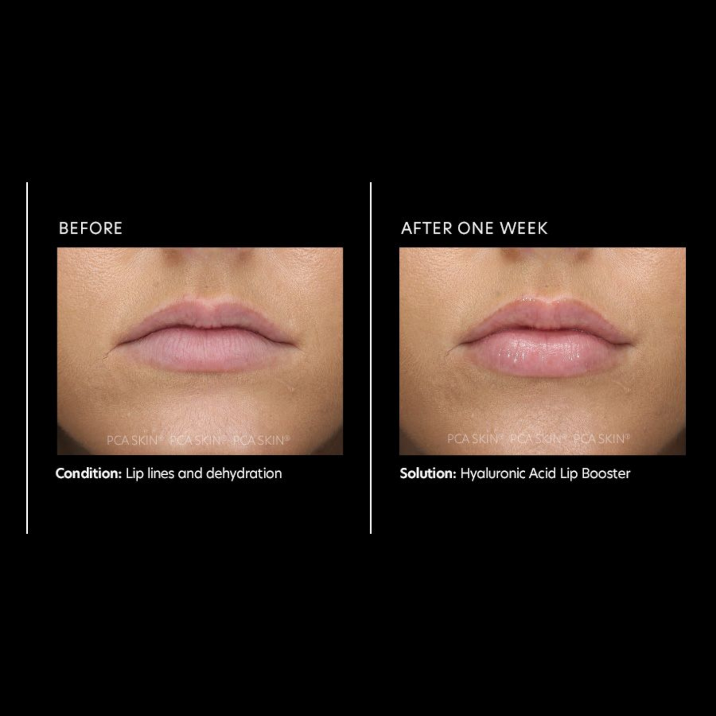 Hyaluronic Acid Lip Booster | PCA Skin