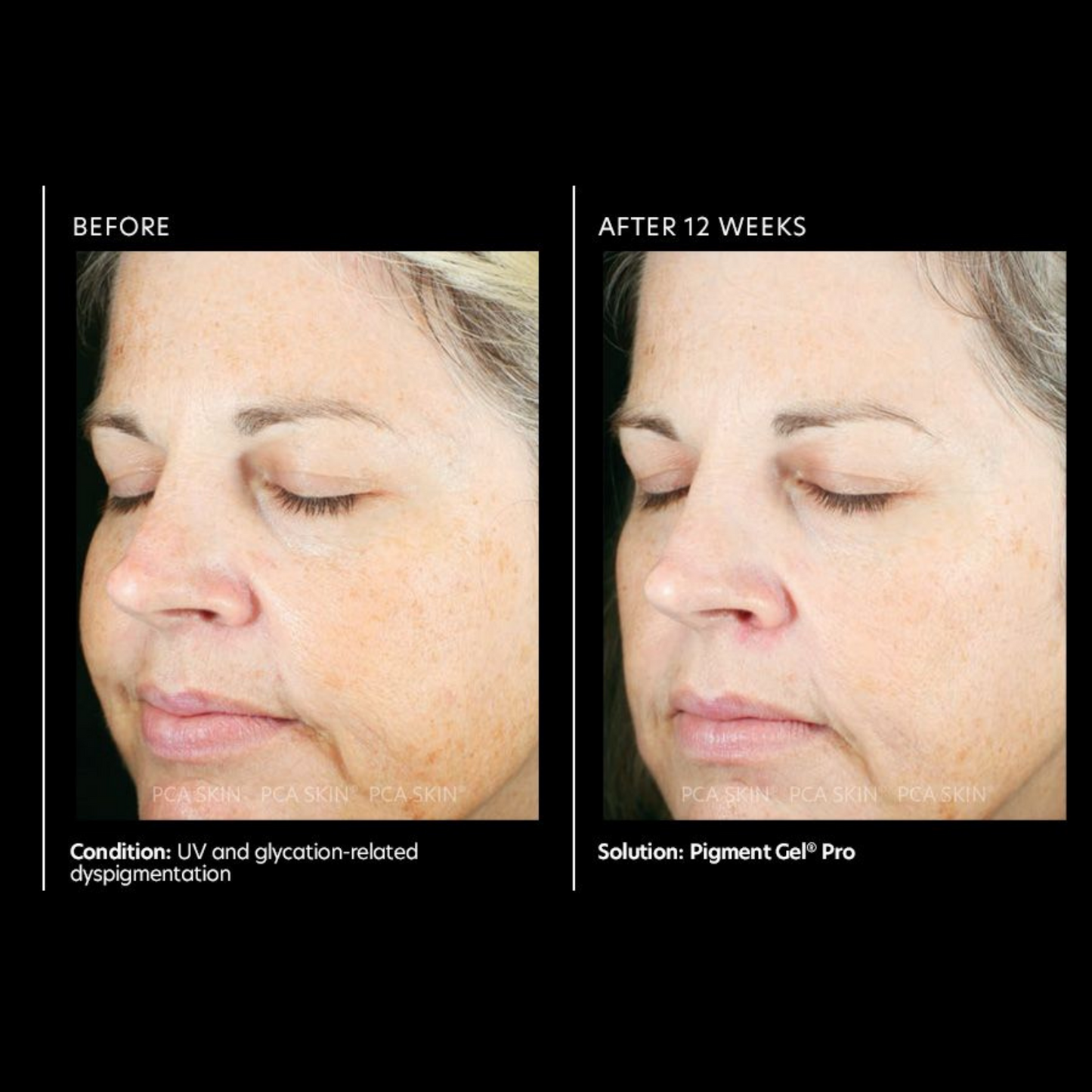 Pigment Gel® Pro  | PCA Skin